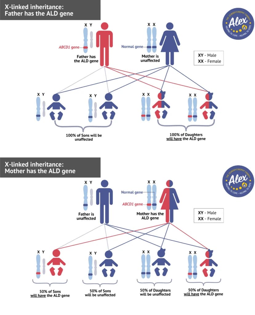 Diagram of X-linked inheritance of the ALD gene: when the father carries the ABCD1 variant, all daughters inherit it and no sons do; when the mother carries it, each son and each daughter has a 50% chance of inheriting it.